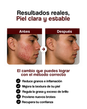 Guía de Implementación Reset del Acné™