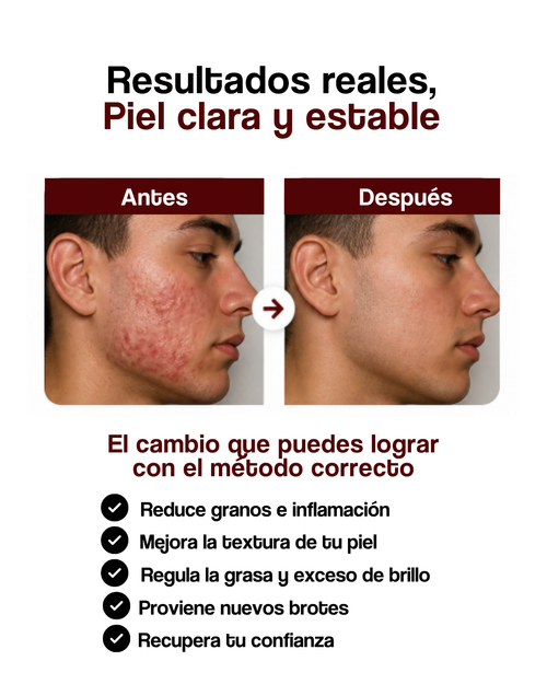 Guía de Implementación Reset del Acné™