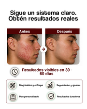 Guía de Implementación Reset del Acné™